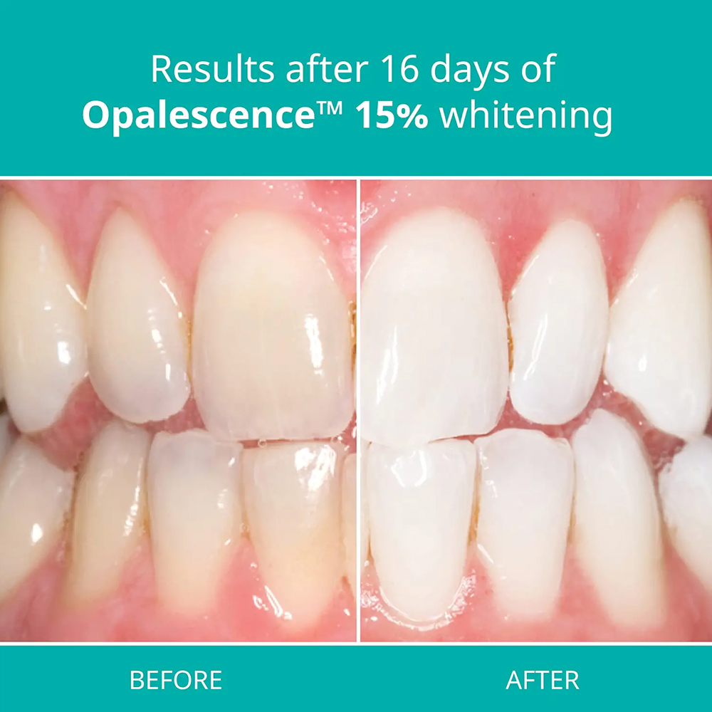 Opalescence Profesyonel Beyazl - Teeth Whitening Gel Refills incelemesi ve fiyatı