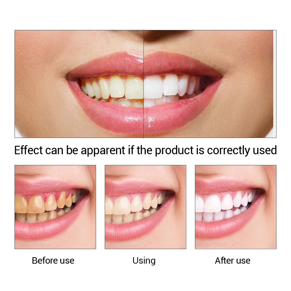 FTEENPLY diş beyazlatma özü to - Teeth Whitening Street incelemesi ve fiyatı
