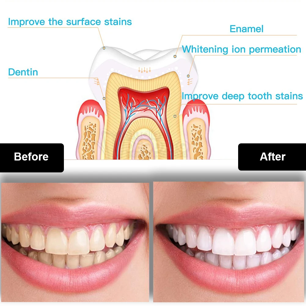 Diş Diş Beyazlatma Kiti Mini 1 - Teeth Whitening With Blue Light incelemesi ve fiyatı